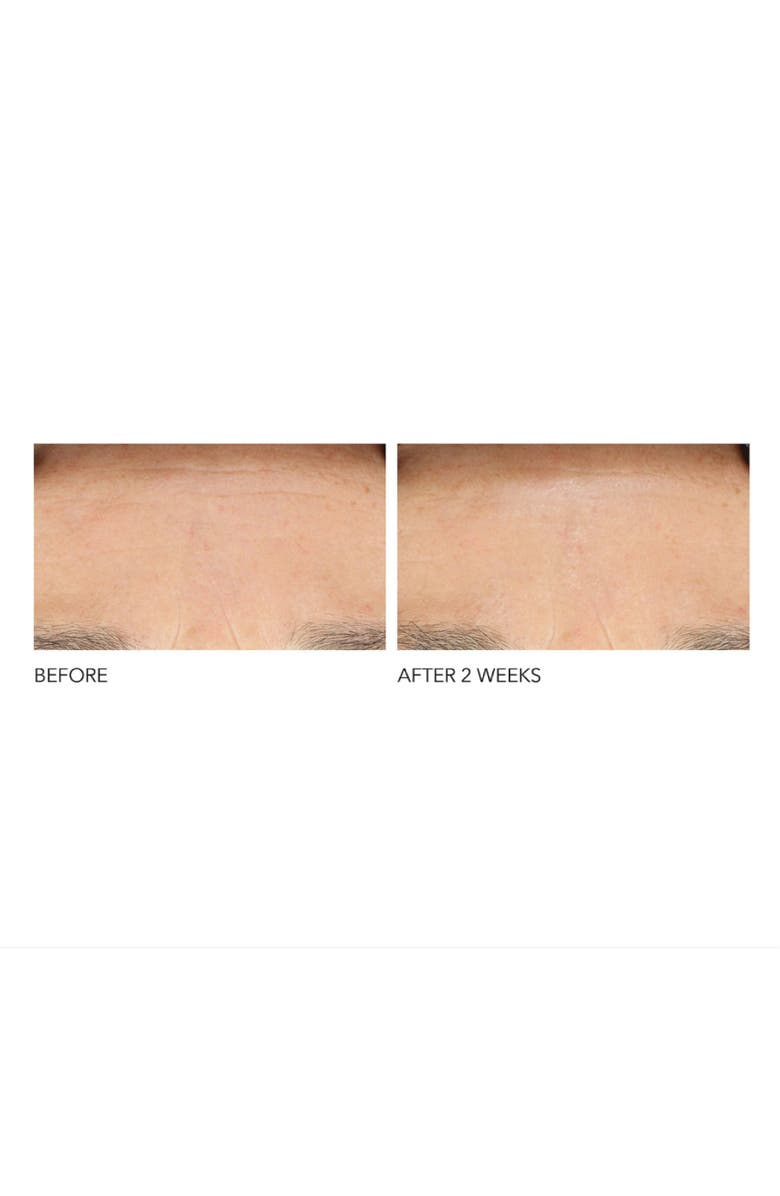 Dr. Dennis Gross Skincare Clinical Grade Resurfacing Liquid Peel, Alternate, color, 