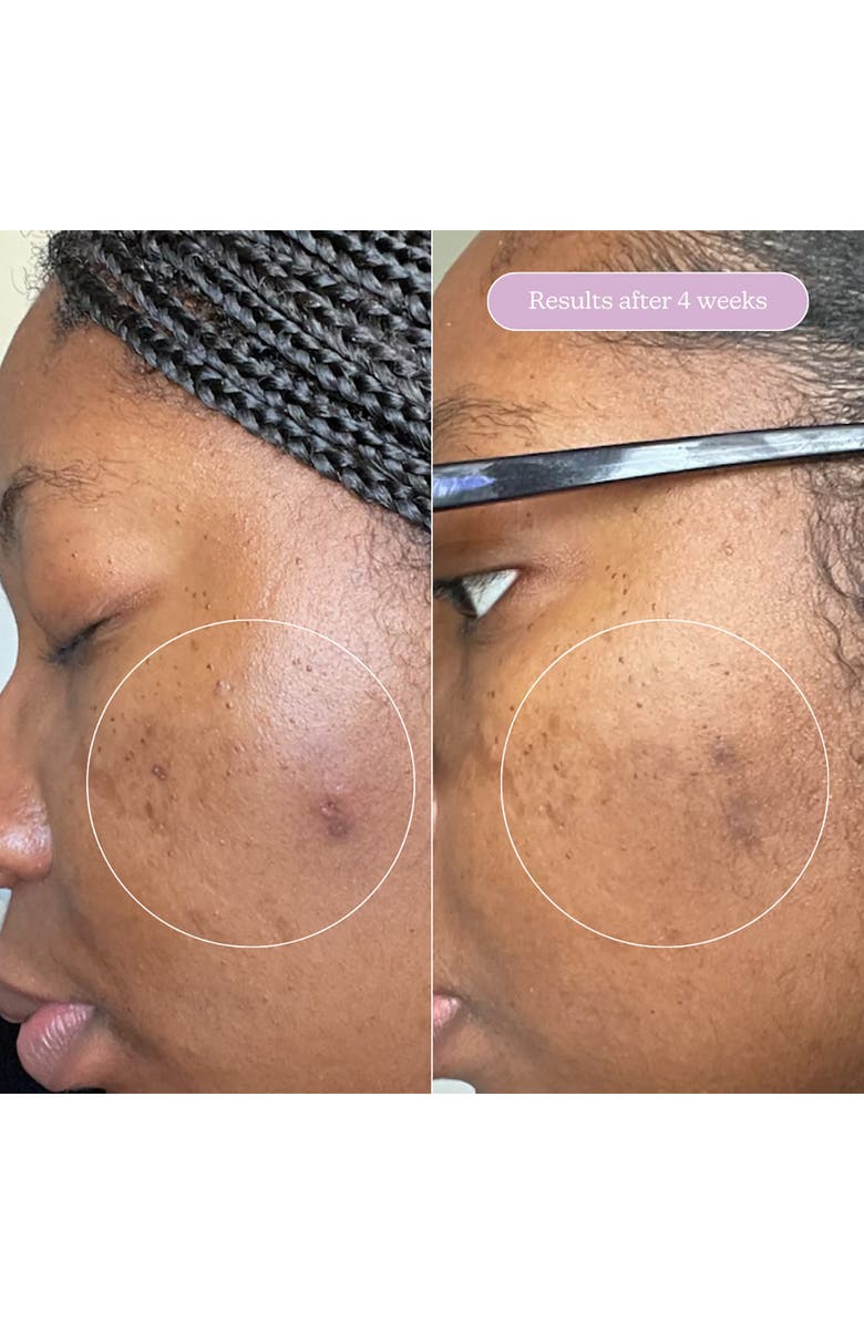 BLUME Milky Fade Spot & Scar Fade Serum, Alternate, color, 