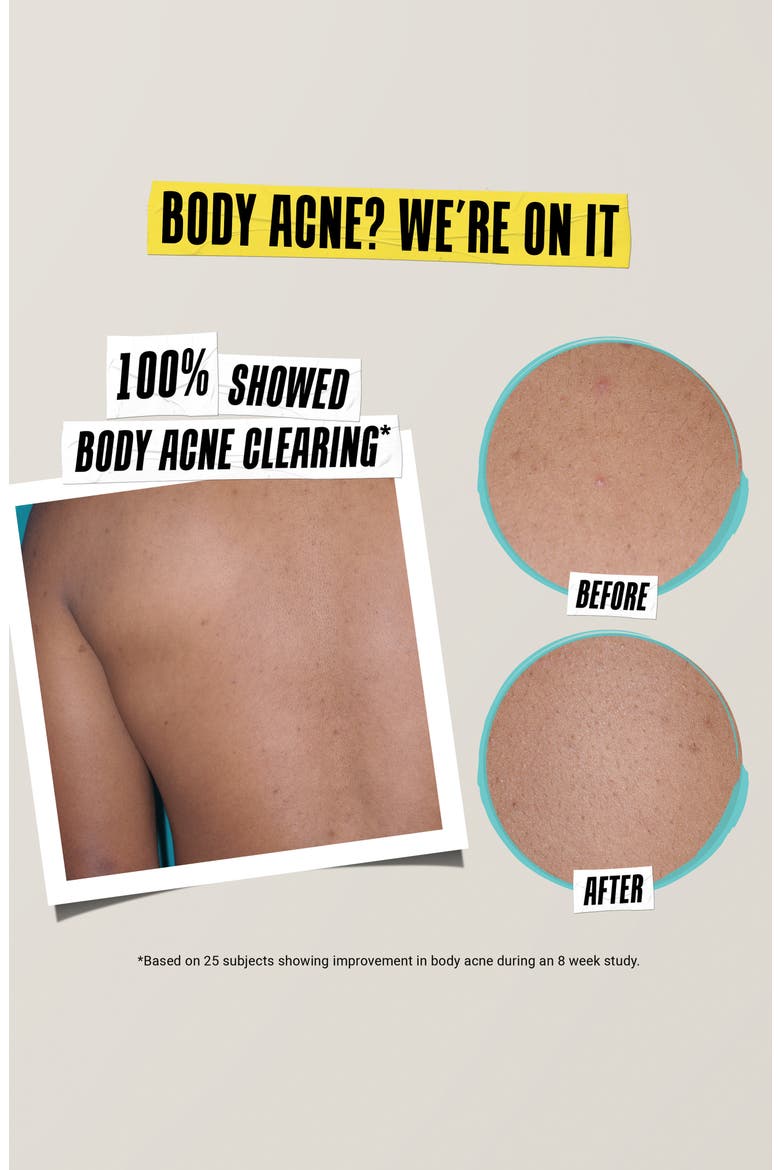 Truly Targeted Acne Clearing Solution, Alternate, color, NO COLOR