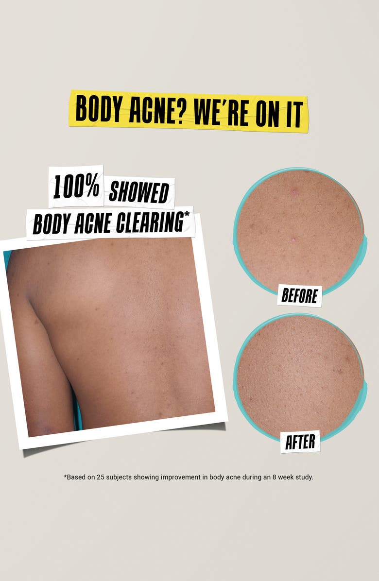 Kiehl's Since 1851 Truly Targeted Acne Clearing Solution, Alternate, color, 