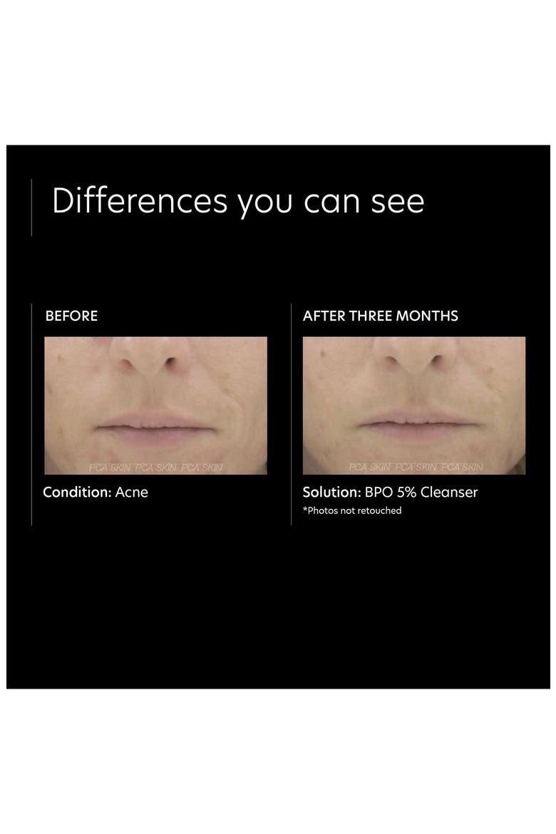 BPO 5% Cleanser, Alternate, color, NO COLOR