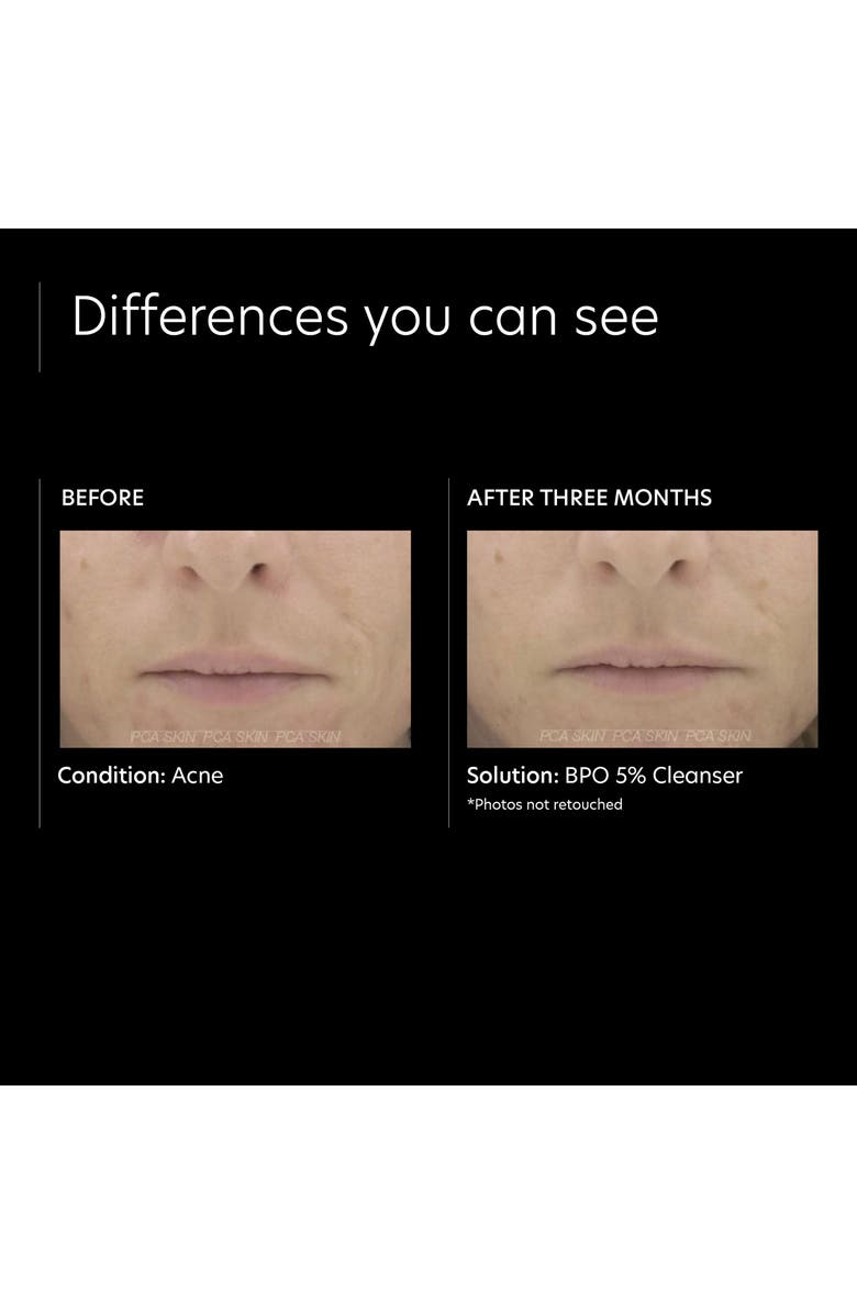 PCA Skin BPO 5% Cleanser, Alternate, color, 