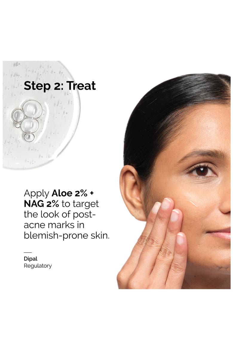 Aloe 2% + NAG 2% Solution for Post-Acne Marks, Alternate, color, NO COLOR