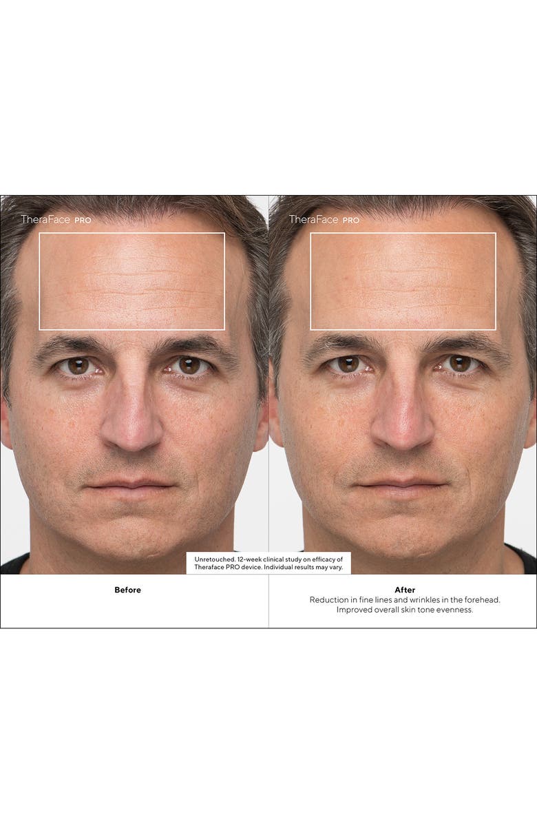 Therabody TheraFace PRO Set, Alternate, color, Black