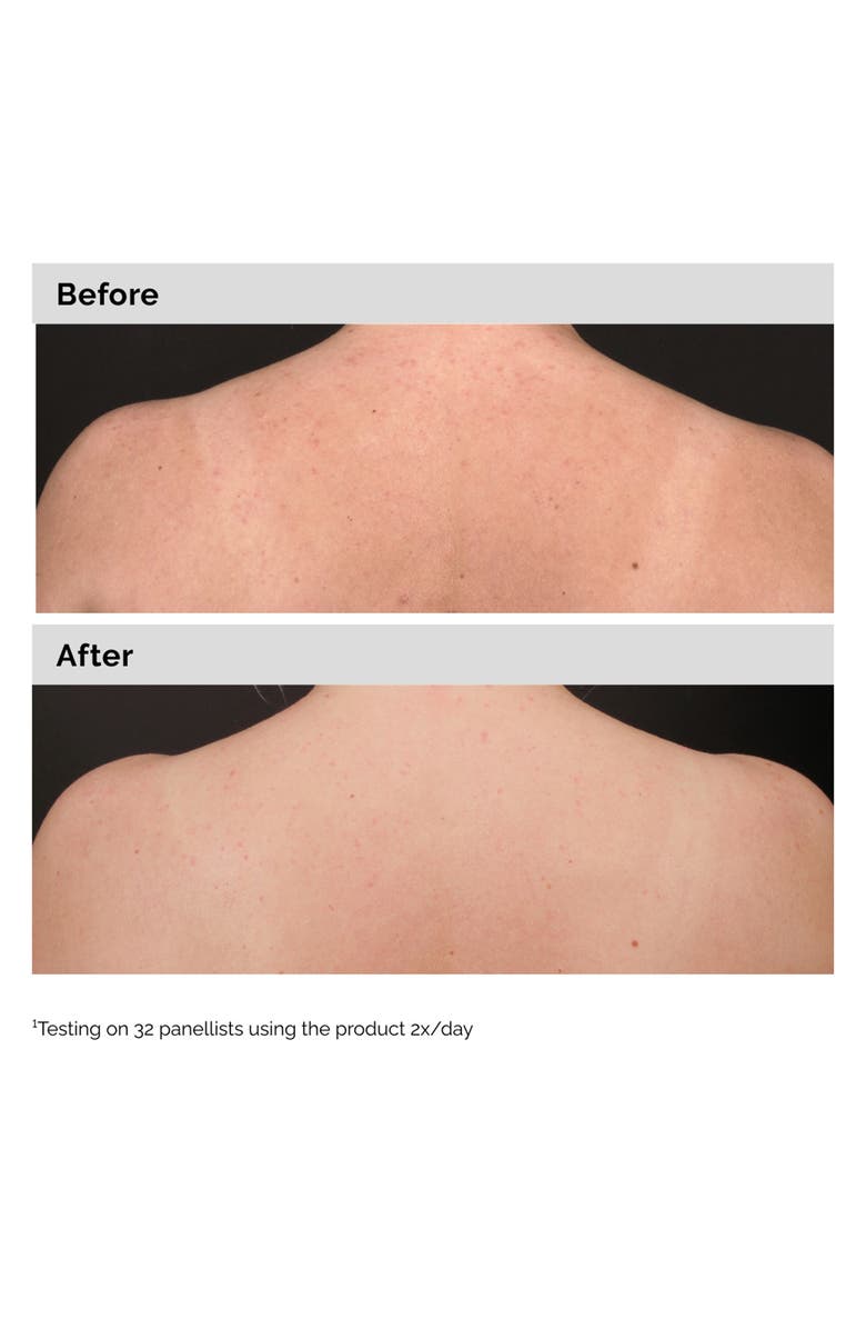 The Ordinary Salicylic Acid 0.5% Body Serum Exfoliating Treatment for Acne, Alternate, color, 