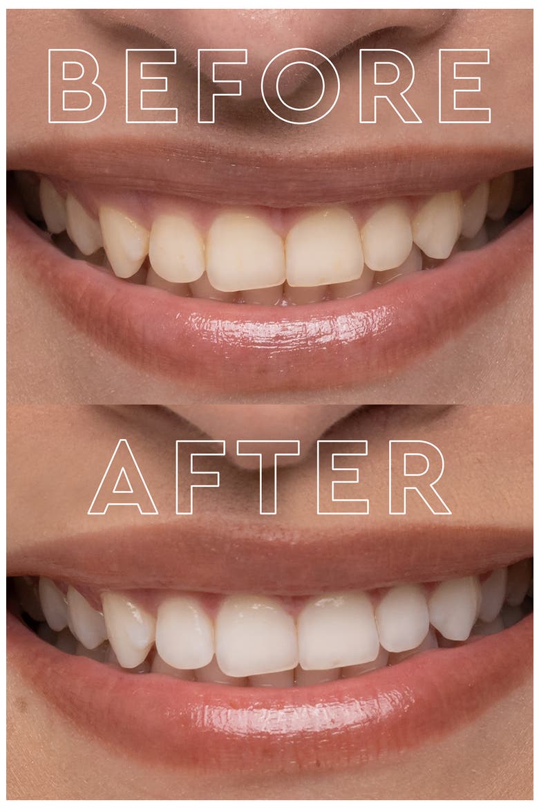 The Teeth Whitening Device System, Alternate, color, NO COLOR