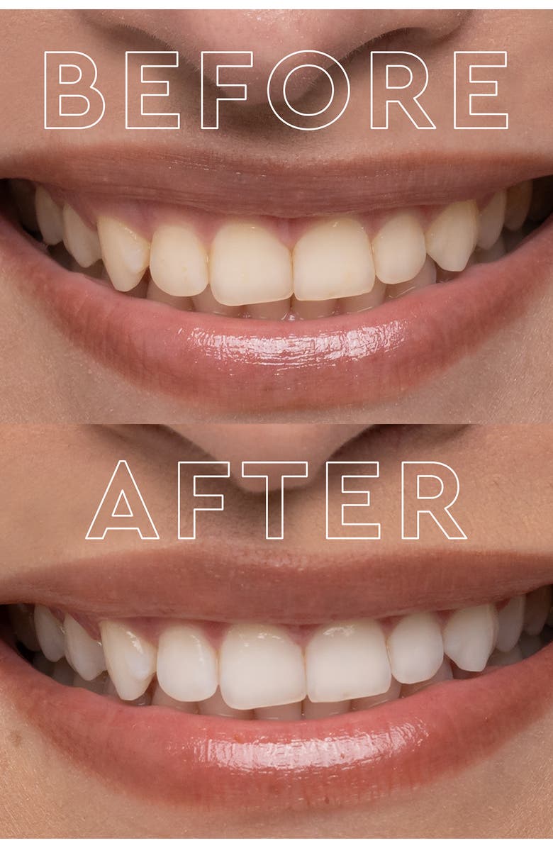 MOON The Teeth Whitening Device System, Alternate, color, 