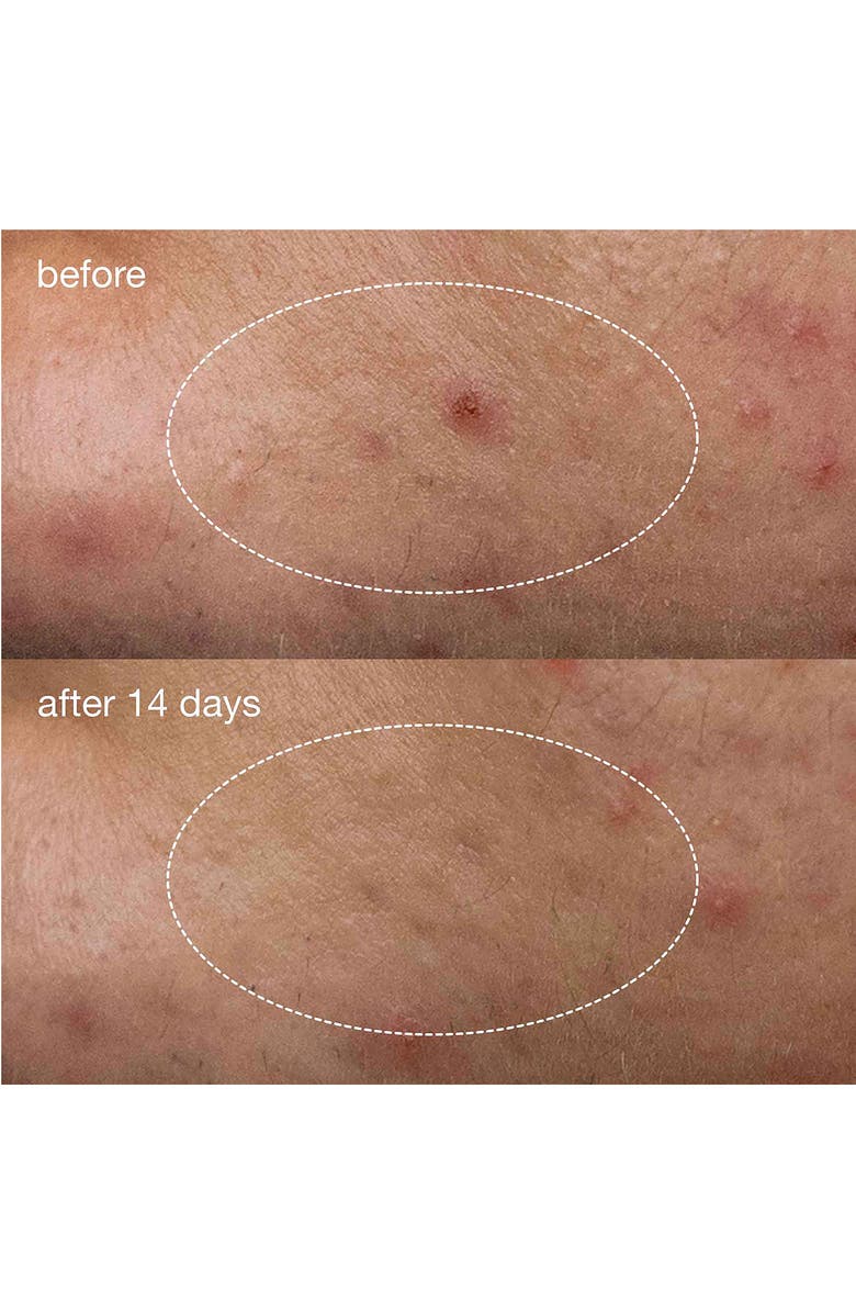 dermalogica<sup>®</sup> Deep Acne Liquid Patch, Alternate, color,