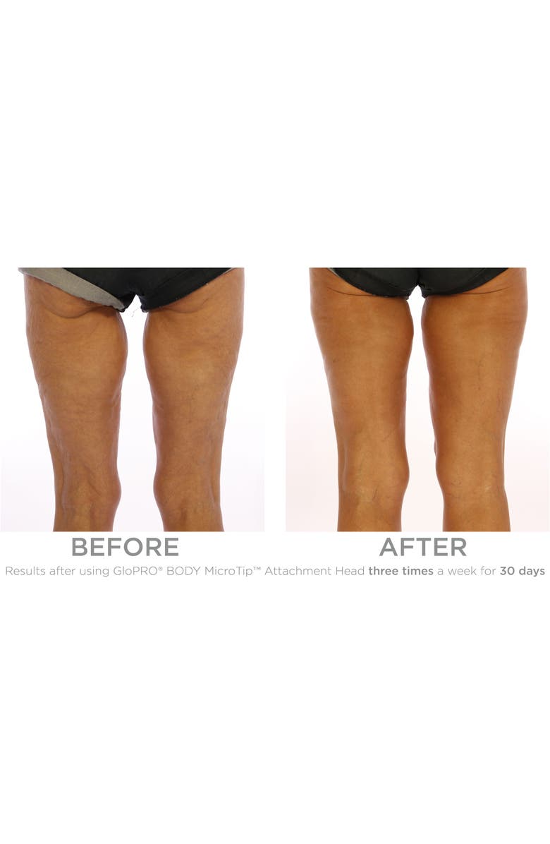 BeautyBio GloPRO<sup>®</sup> Microneedling Regeneration Tool with FACE & BODY MicroTip<sup>™</sup> Attachments, Alternate, color, 