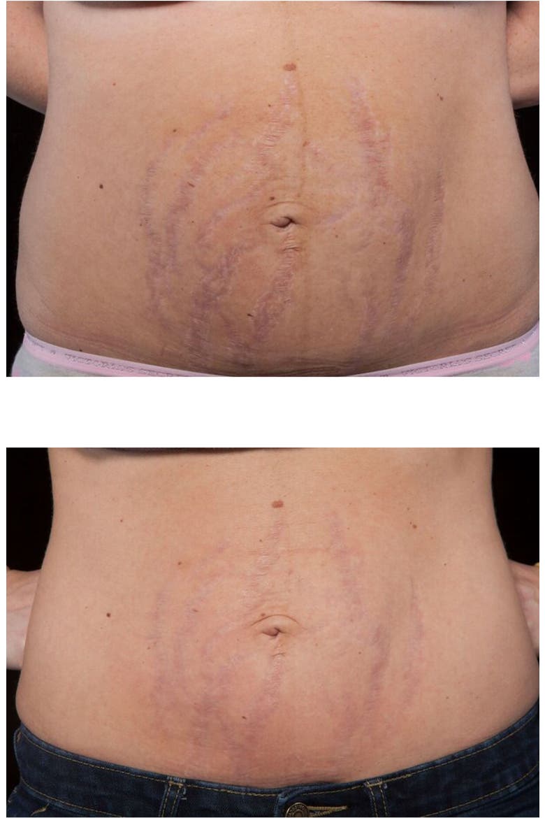 Stretch Mark LED Treatment Device, Alternate, color, WHITE