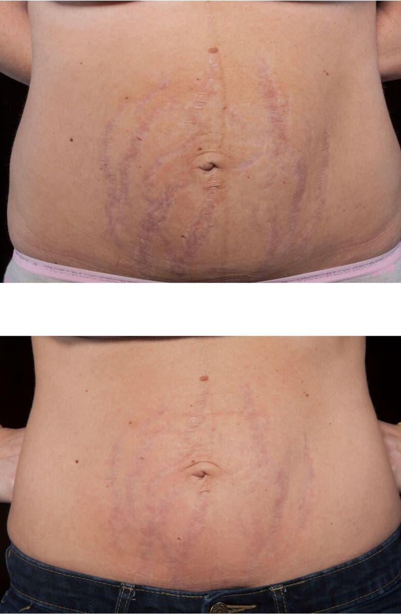 Strialite Stretch Mark LED Treatment Device, Alternate, color, 