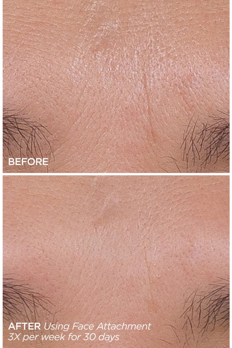 Get That Glow GloPRO® Facial Microneedling Discovery Set $233 Value, Alternate, color, NO COLOR
