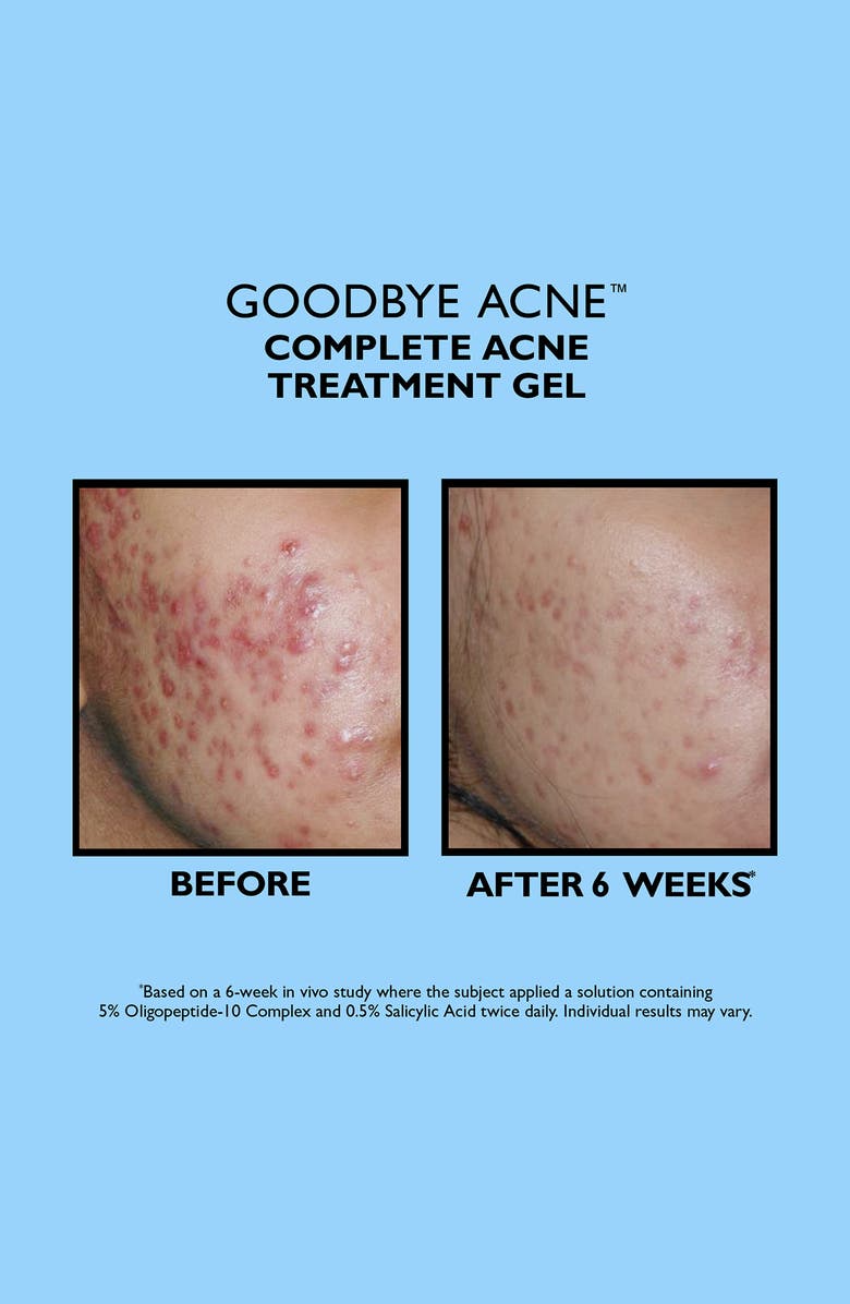 Peter Thomas Roth Goodbye Acne Acne Treatment Set (Limited Edition) $92 Value, Alternate, color, 