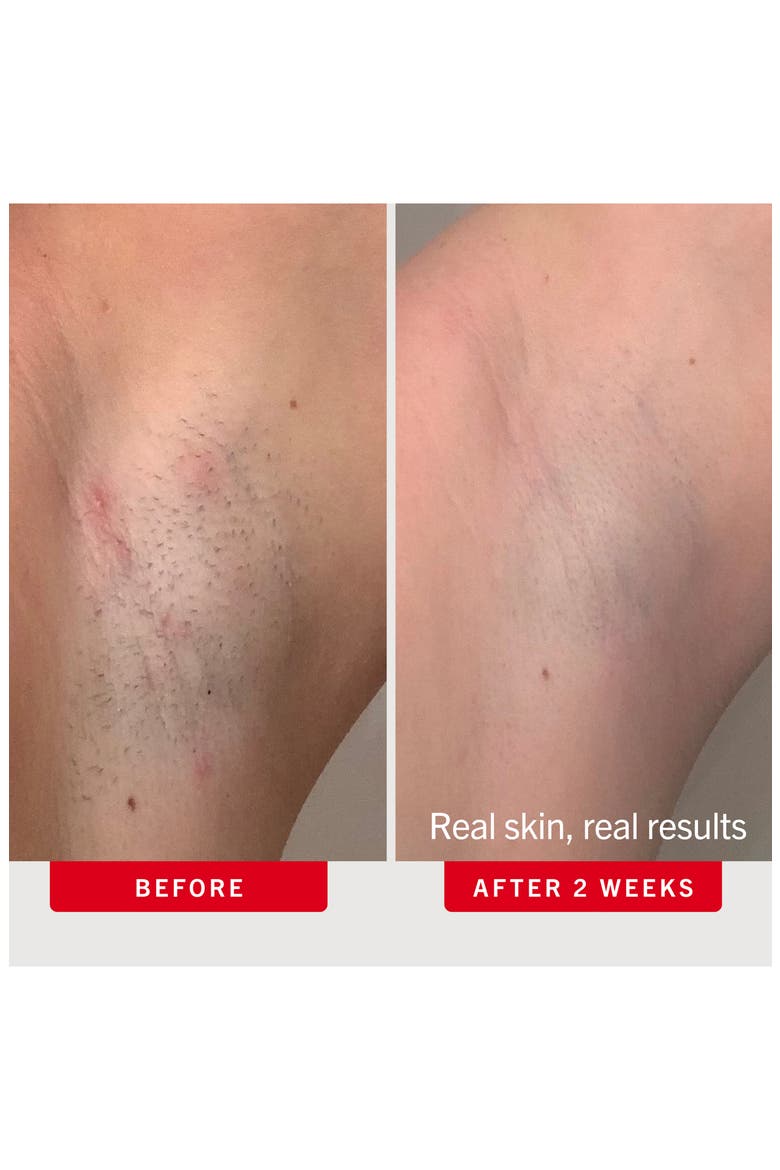 Ingrown Hair Pads Body & Face With BHA & AHA, Alternate, color, NO COLOR