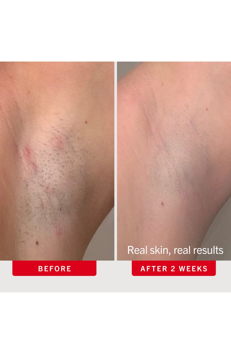 First Aid Beauty Ingrown Hair Pads Body & Face With BHA & AHA, Alternate, color, 