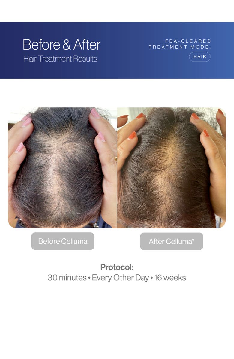 Celluma RESTORE Hair System, Alternate, color, Blue