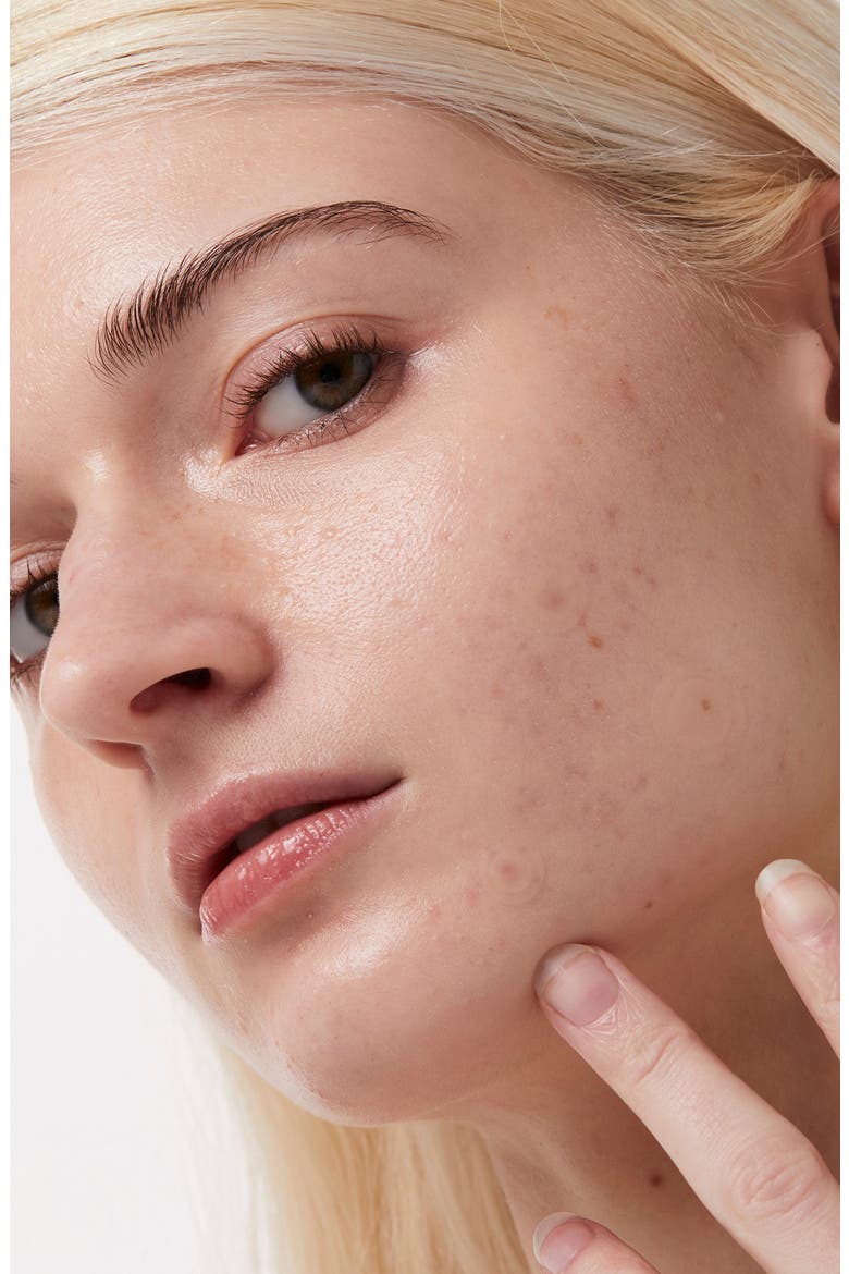 Timeout Blemish Patches, Alternate, color, NO COLOR