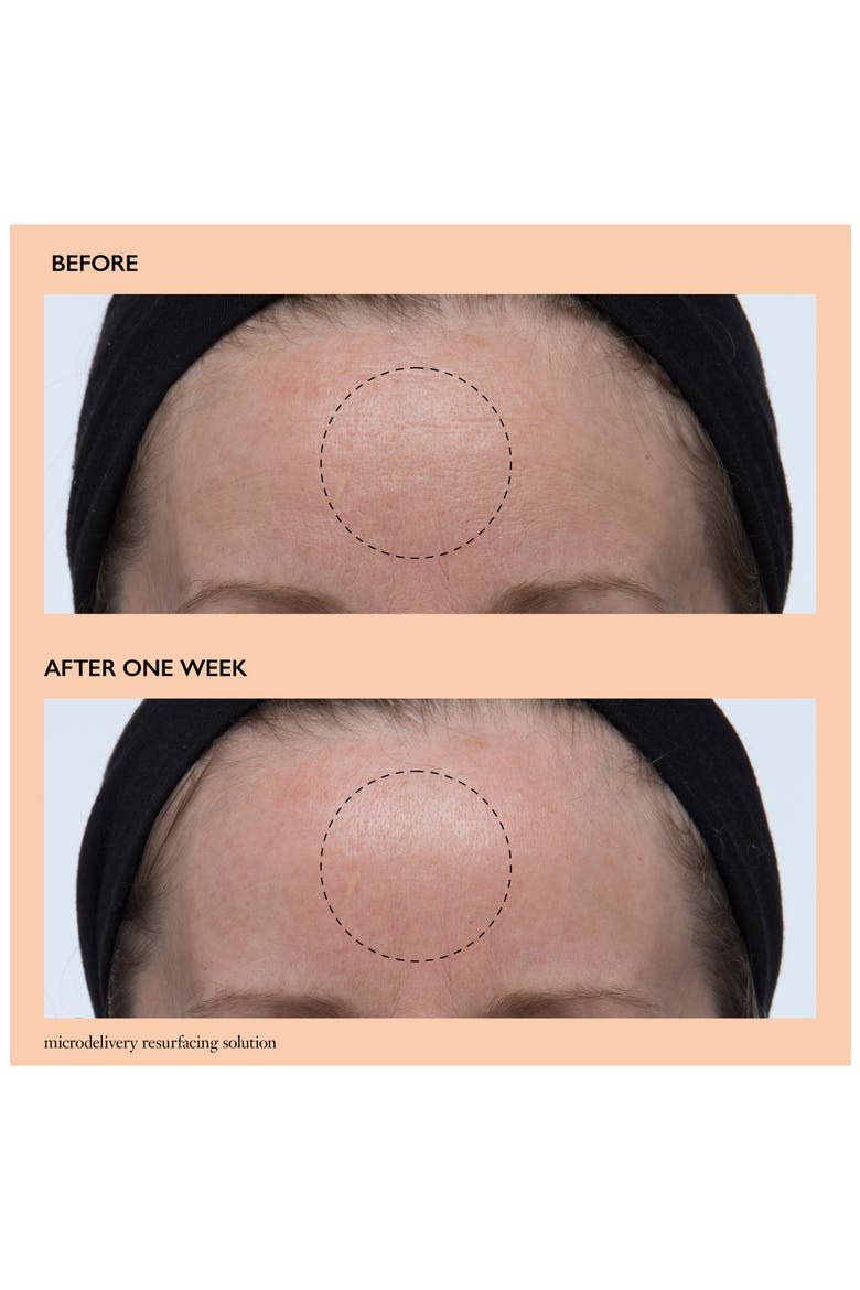 microdelivery resurfacing solution, Alternate, color, NO COLOR