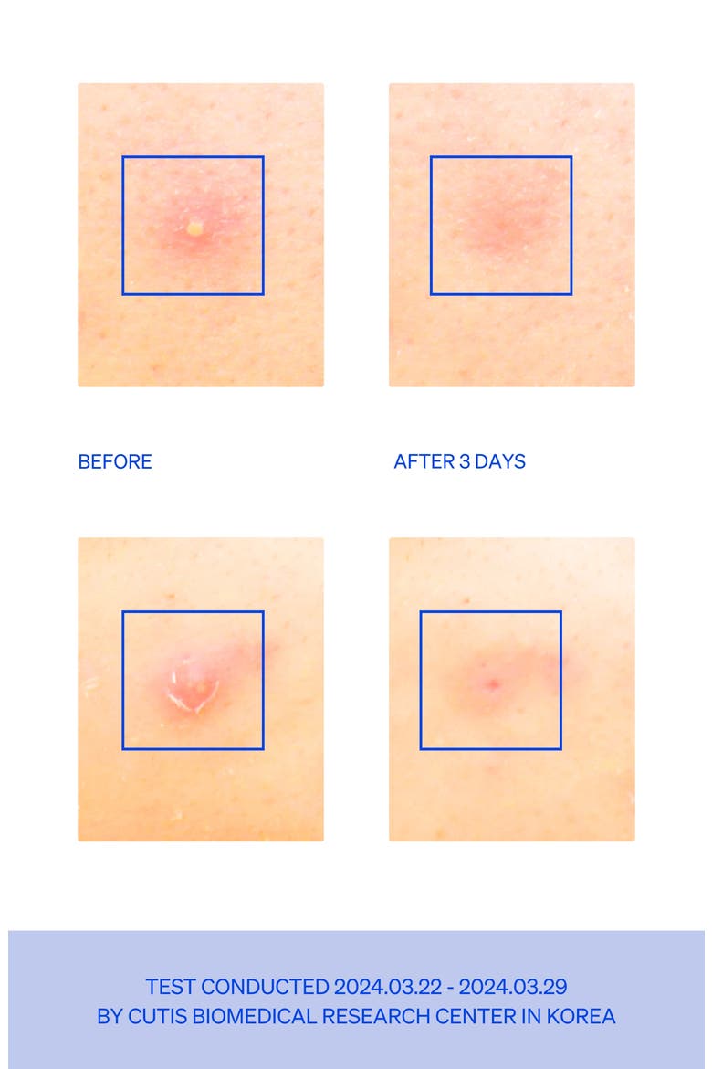 Right Away Microtip Spot Patches, Alternate, color, BLUE