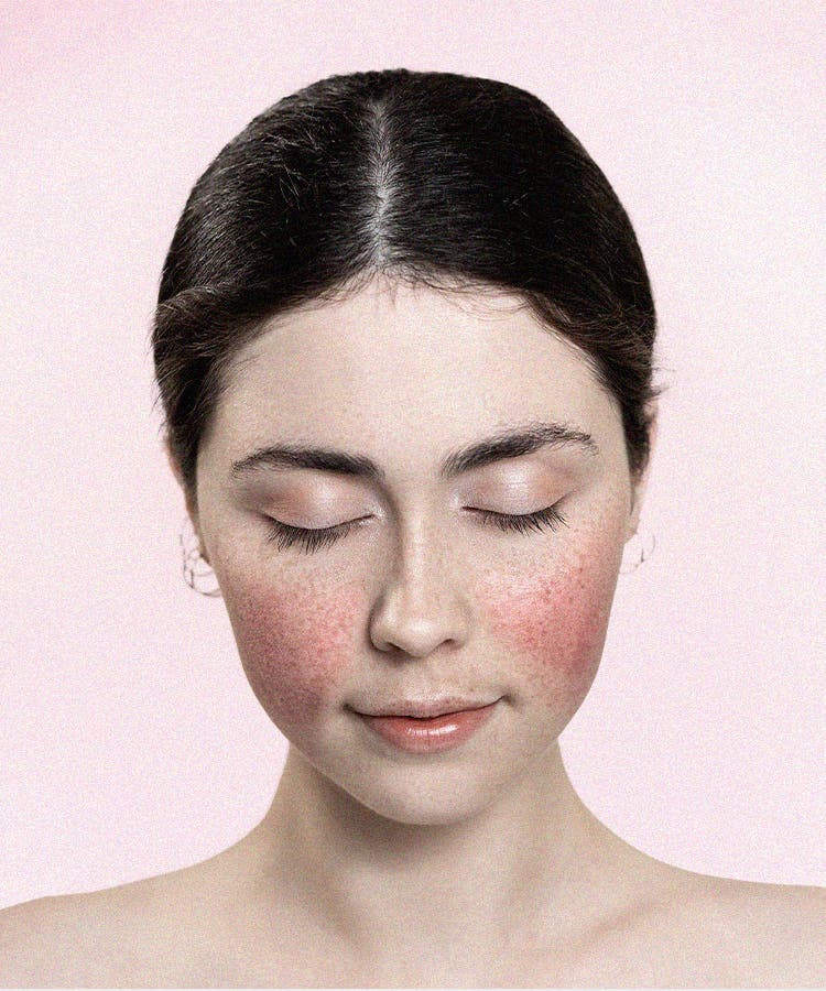 The Best Makeup For Rosacea