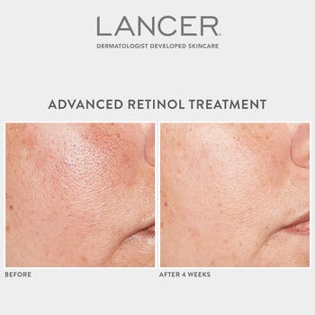 Advanced Retinol Treatment