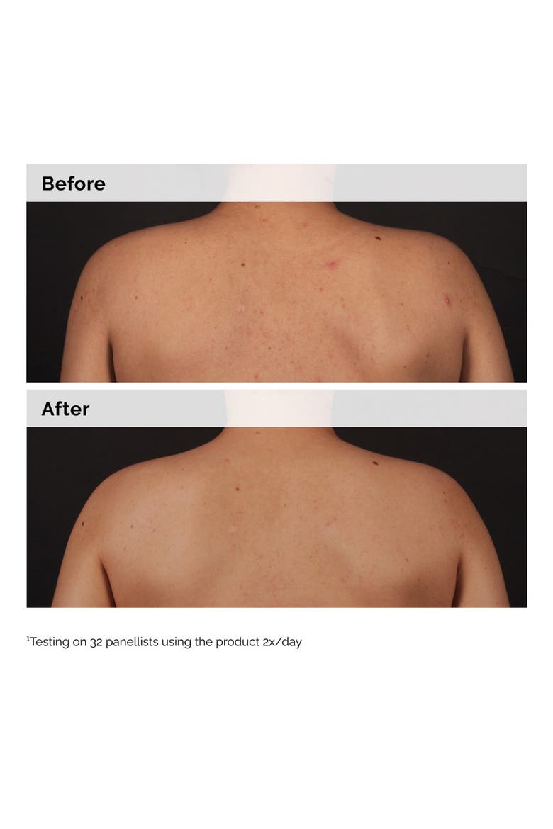 Salicylic Acid 0.5% Body Serum Exfoliating Treatment for Acne, Alternate, color, NO COLOR