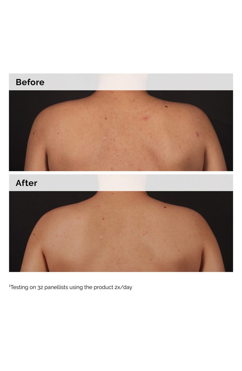 The Ordinary Salicylic Acid 0.5% Body Serum Exfoliating Treatment for Acne, Alternate, color, 