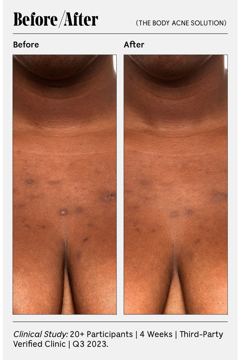 The Body Acne Solution, Alternate, color, NO COLOR