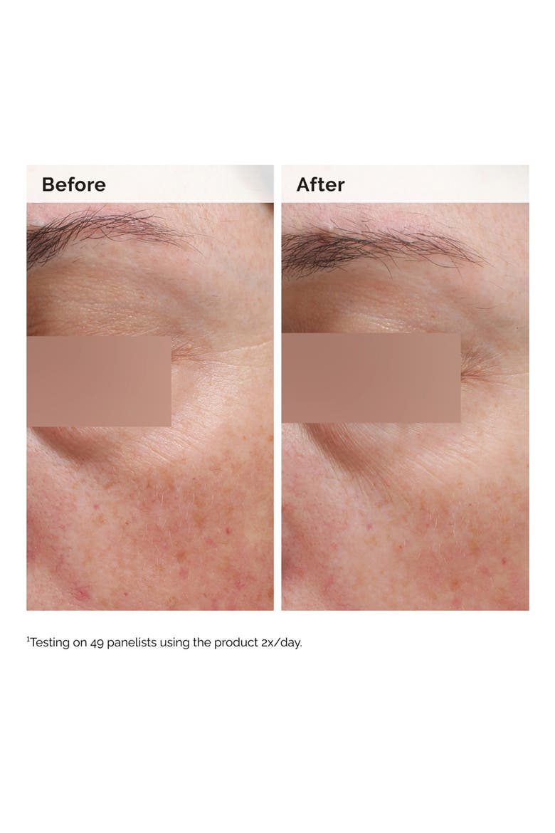 Salicylic Acid 0.5% Body Serum Exfoliating Treatment for Acne, Alternate, color, NO COLOR