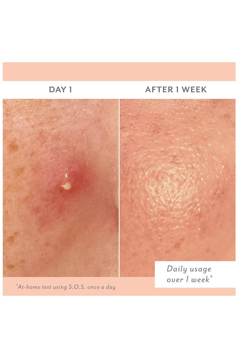 S.O.S. Clarifying Liquid Patch, Alternate, color, NO COLOR