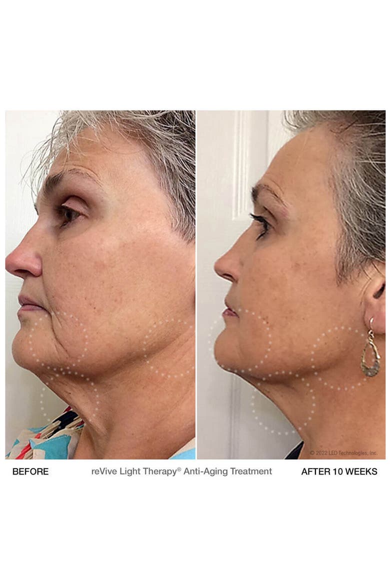 Lux dpl IIa LED Full Face Wrinkle & Acne Treatment Panel, Alternate, color, NO COLOR