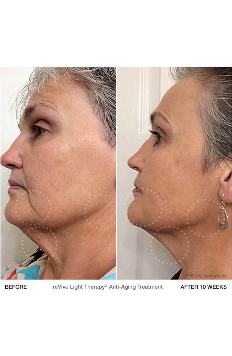 REVIVE LIGHT THERAPY Lux dpl IIa LED Full Face Wrinkle & Acne Treatment Panel, Alternate, color, 