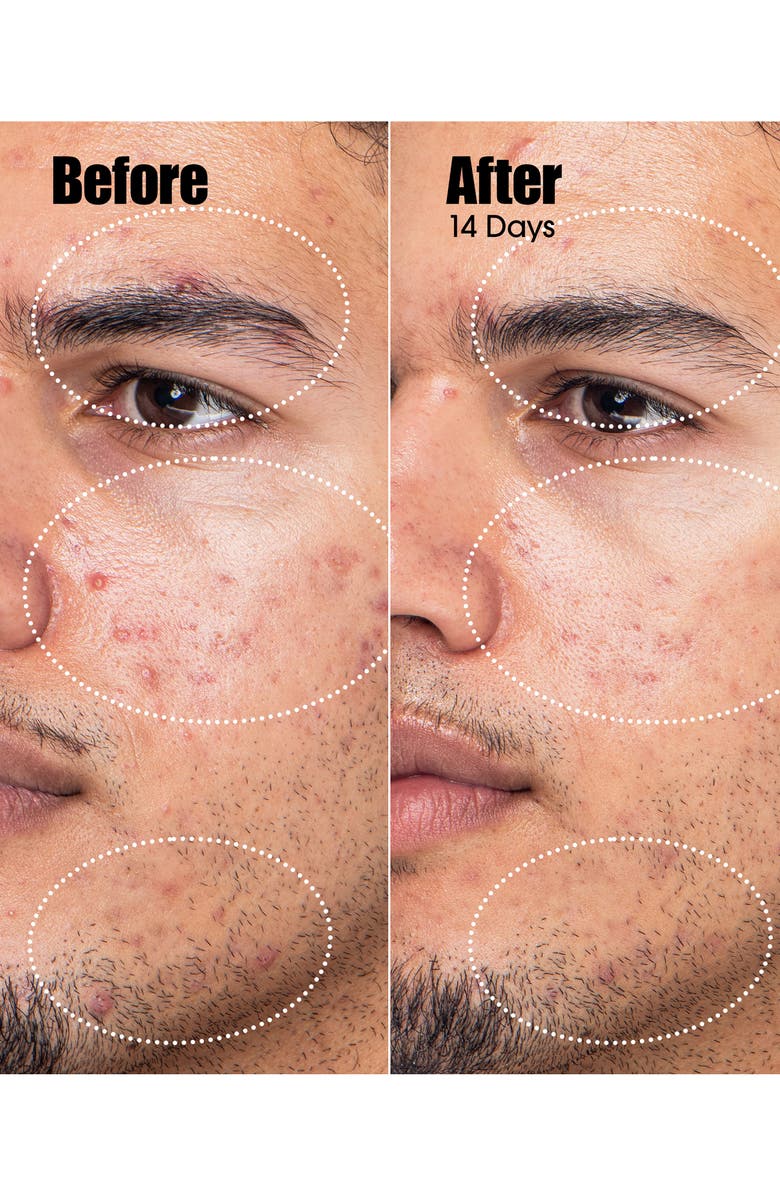 Sunday Riley Peacekeeper Acne Treatment Serum, Alternate, color, 