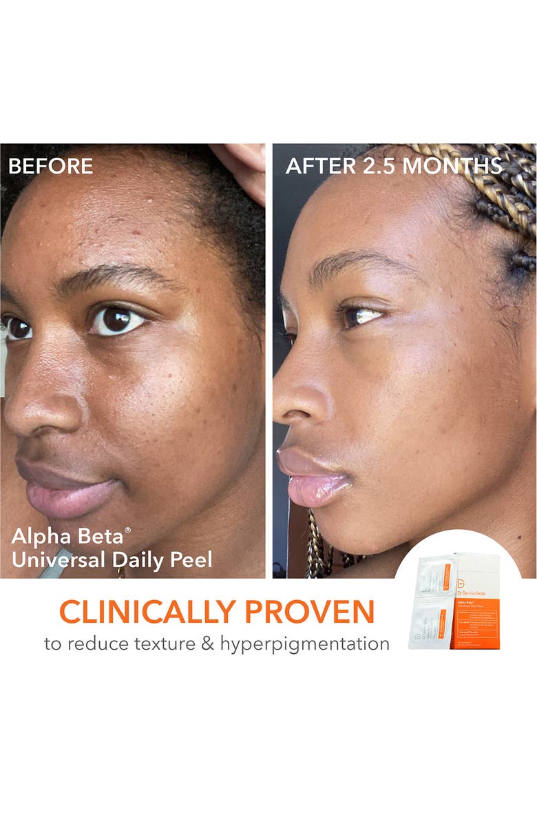 Dr. Dennis Gross Skincare The Holiday Peel Vault Duo (Limited Edition) USD $245 Value, Alternate, color,