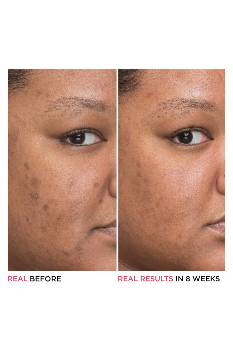 IT Cosmetics Bye Bye Dark Spots Niacinamide Serum, Alternate, color, 