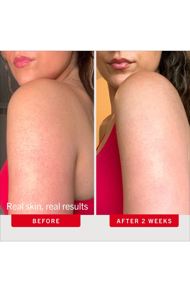 First Aid Beauty KP Bump Eraser Body Scrub with 10% AHA Fresh Peach, Alternate, color, 