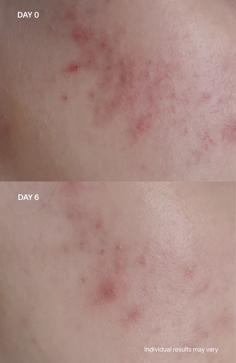 SolaWave Bye Acne 3-Minute Light Therapy Acne Spot Device, Alternate, color, 