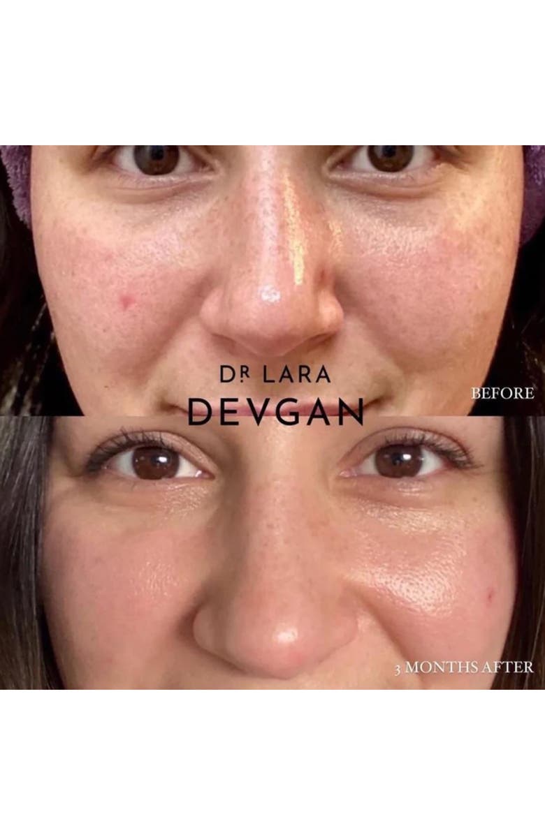 Dr. Lara Devgan Retinol + Bakchiol Serum, Alternate, color,