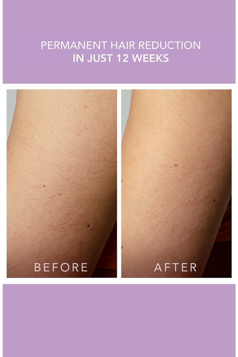PEACH 2 Go Advanced Hair Removal Device, Alternate, color, LAVENDER