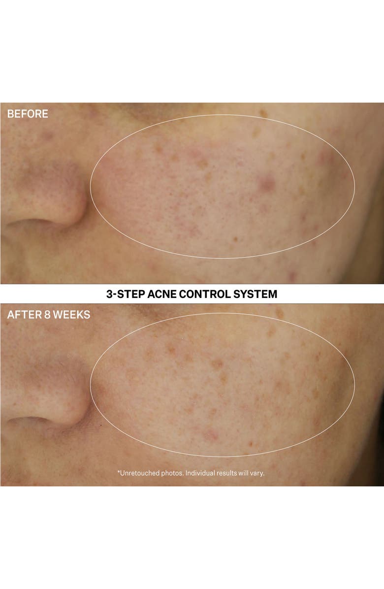 StriVectin<sup>®</sup> Multi-Action Clear: Acne Clearing Treatment Lotion, Alternate, color, 