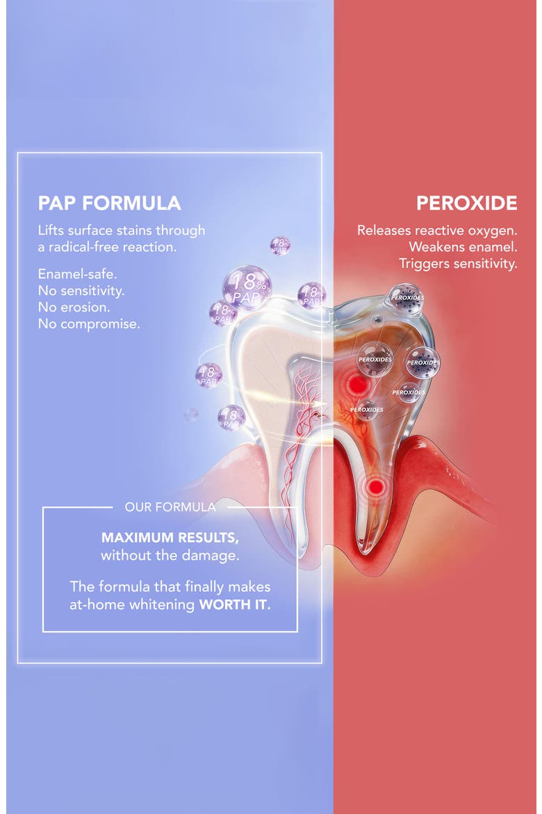 ISSA LED Teeth Whitening Kit, Alternate, color, LAVENDAR