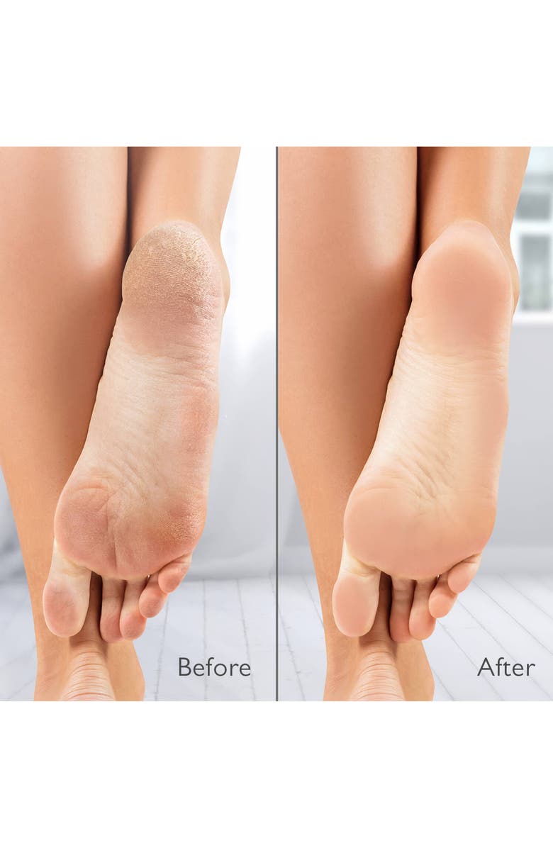 Silk'n VacuPedi, Alternate, color, White