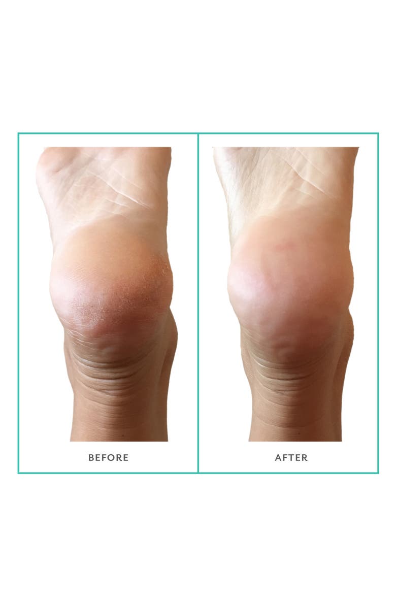 Patchology PoshPeel<sup>™</sup> Pedi Cure Foot Treatment Peel, Alternate, color,