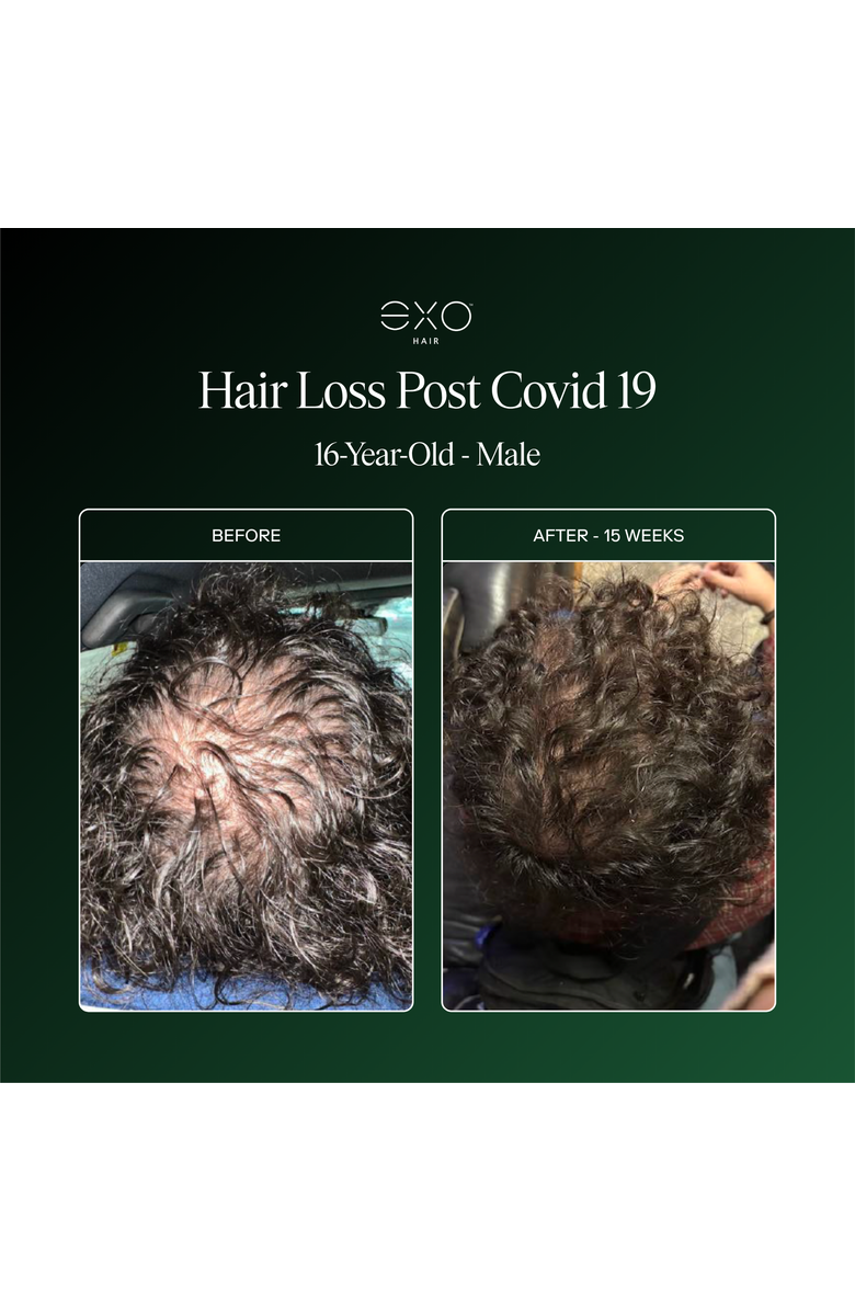 Exoceuticals Exo Activate Follicle Enrichment Serum, Alternate, color, Black