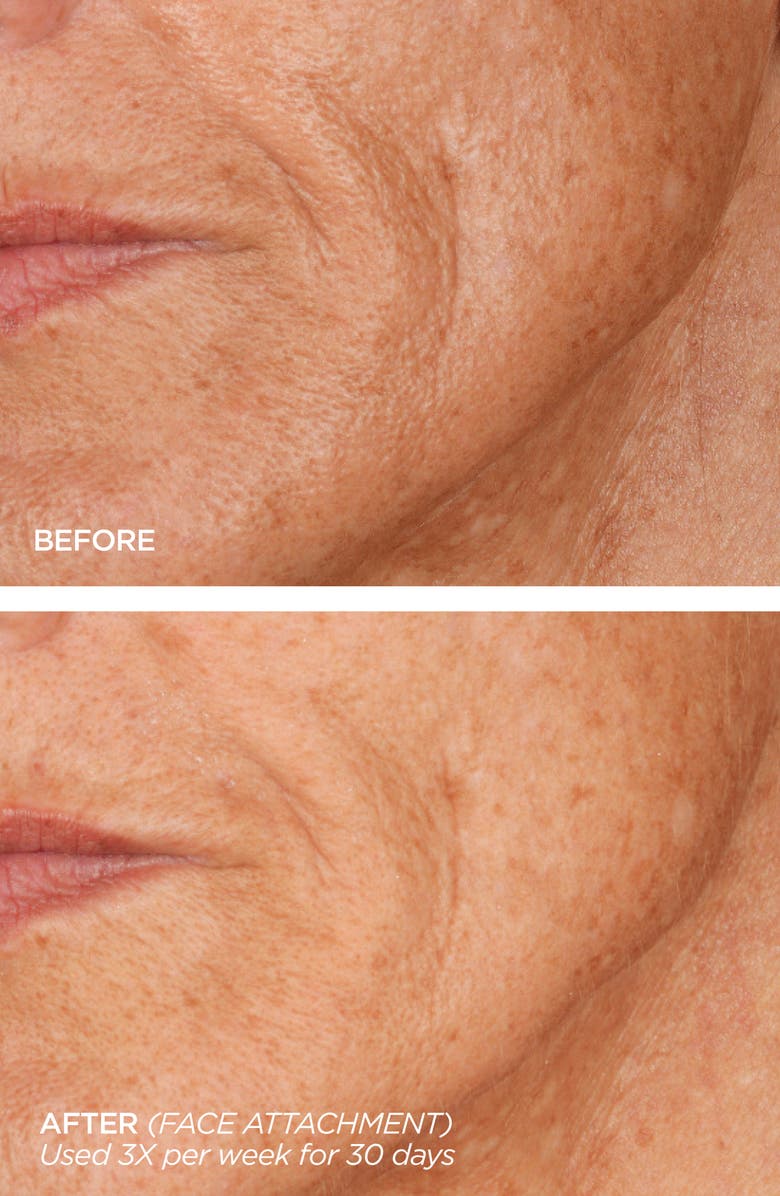 BeautyBio Metallic Gold GloPRO<sup>®</sup> Microneedling Regeneration Tool Set, Alternate, color,