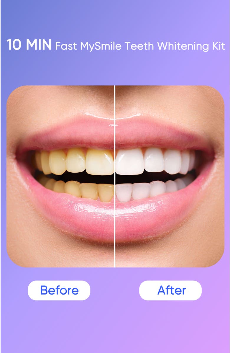 MySmile Ultimate Teeth Whitening Kit with Refills Bundle, Alternate, color, White