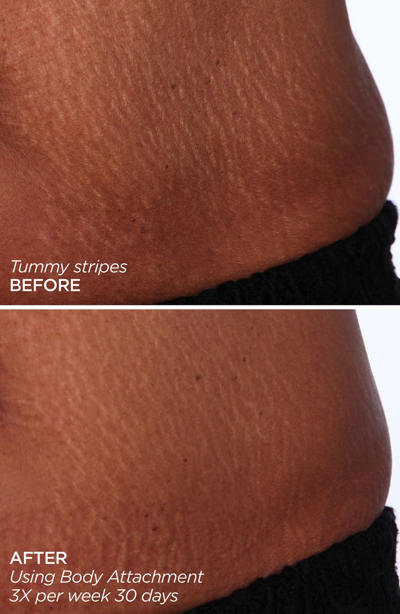 BeautyBio GloPRO<sup>®</sup> BODY MicroTip<sup>™</sup> Attachment Replacement Head, Alternate, color,