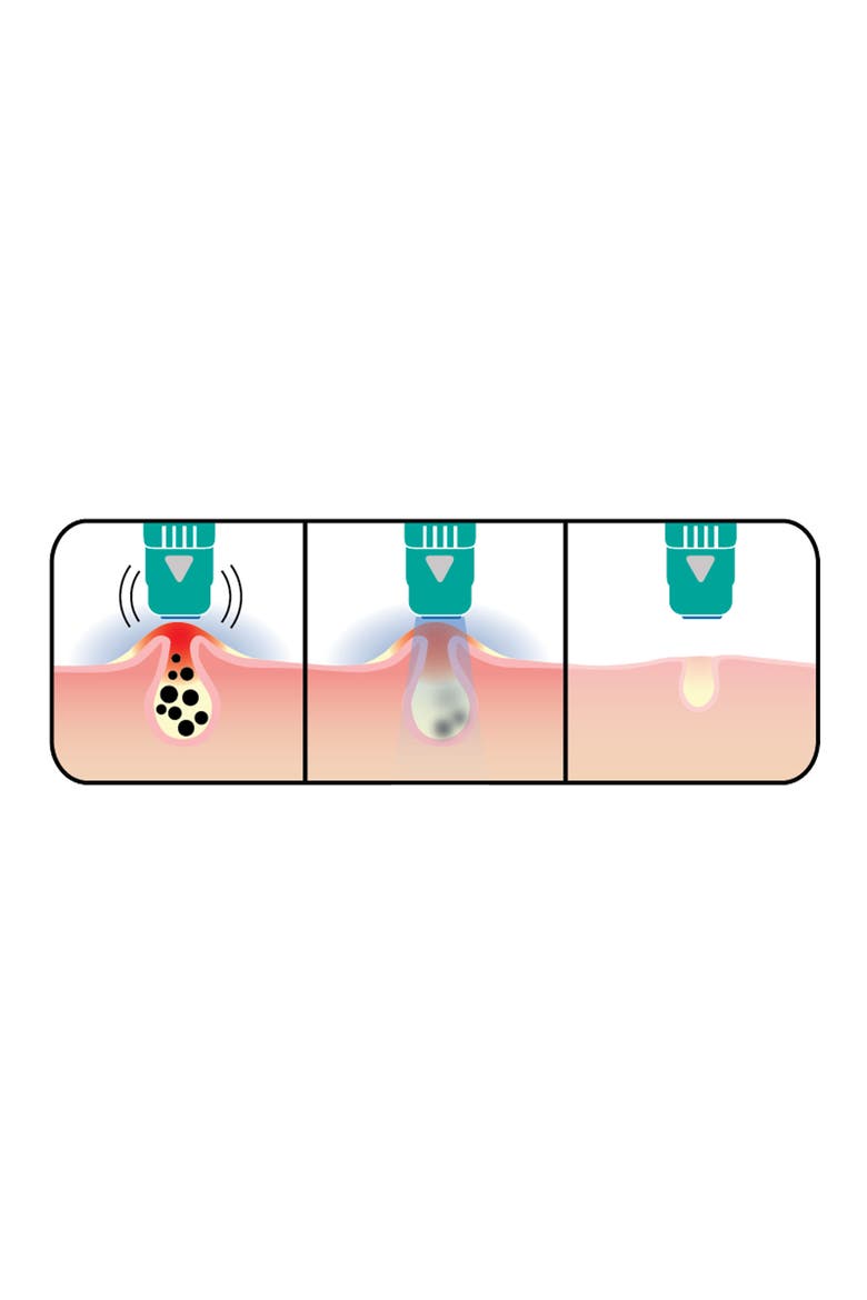 clear Anti-Blemish Device, Alternate, color, NO COLOR