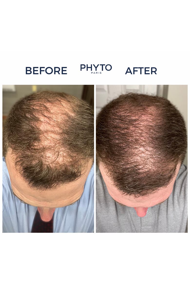 PHYTO Lium 4 Chronic Thinning Hair Treatment, Alternate, color,
