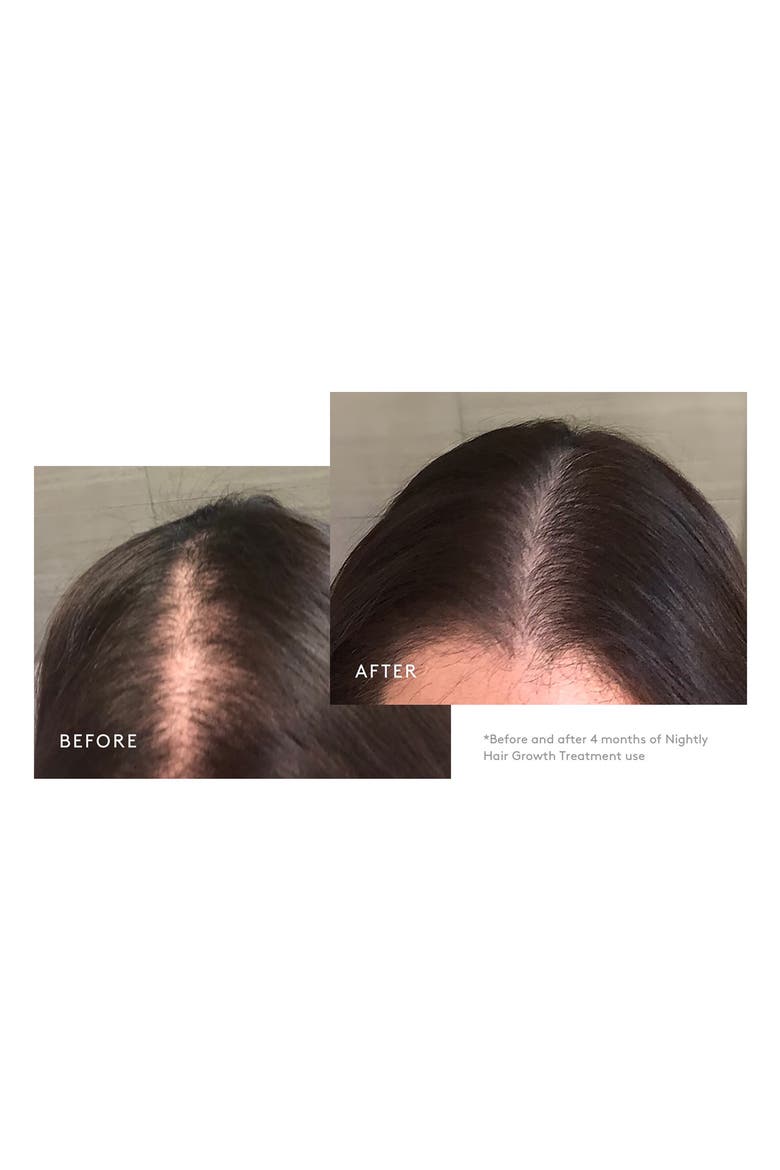 Flourish® Hair Growth Treatment for Moderate to Severe Hair Loss, Alternate, color, 90 DAY
